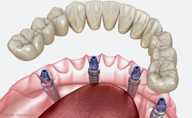 All-On-4: Feste Zähne mit nur vier Zahnimplantaten pro Kiefer