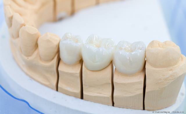 Zahnbrücken - auch aus Keramik - zum Schließen kleiner Zahnlücken