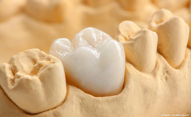 Zahnkronen - auch aus Keramik - zur Erhaltung von Zähnen